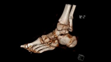 Ayak bileğinin üstündeki kemik (kaval kemiği ve kaval kemiği) kırıklarının hesaplanmış tomografi hacmi görüntüsü (CT VR) 