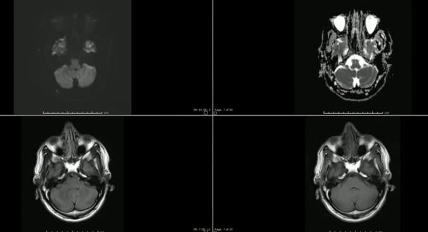 Imagens Ressonância Magnética Infarto Cérebro Modo Cine Mostrando Múltiplas Sequências — Vídeo de Stock