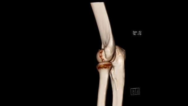 肘关节 Elbow 的放射学检查 Ct体积绘制检查显示内侧中肠骨折 — 图库视频影像