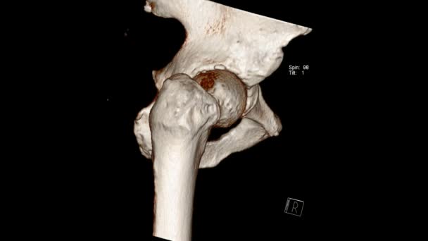 Examen Radiológico Tomografía Computarizada Volumen Representación Examen Articulación Cadera Hip — Vídeos de Stock