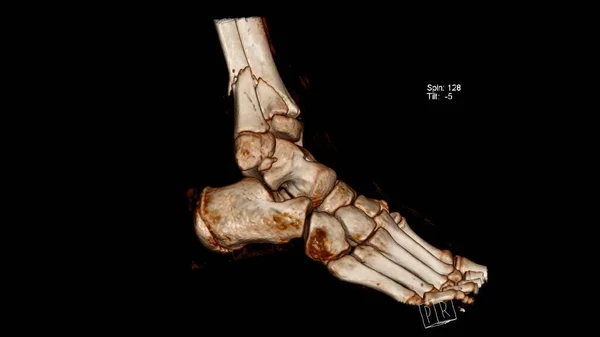 踝关节上胫骨 胫骨和腓骨 骨折的计算机断层显像 — 图库照片