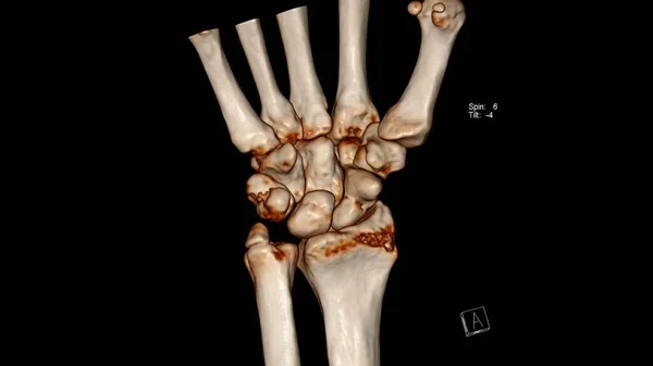 腕关节 Vr腕关节 的放射学检查 Ct体积绘制检查显示肩胛骨及尺形体骨折 — 图库照片
