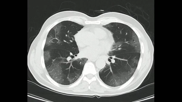 Computed Tomography of the chest (high resolution CT chest)  in a confirmed case of COVID-19 (Corona virus) showing changes in both lungs with ground glass opacity