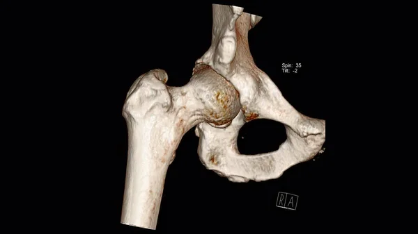 Badanie Radiologiczne Tomografia Komputerowa Badanie Objętości Stawu Biodrowego Hip — Zdjęcie stockowe