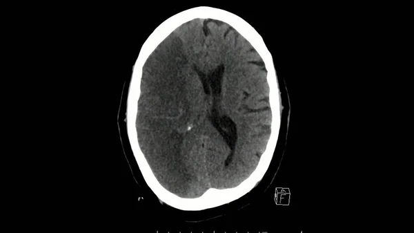 脑轴向切开术显示大块右中脑梗死的计算机断层扫描 — 图库照片