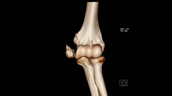 肘关节 Elbow 的放射学检查 Ct体积绘制检查显示内侧中肠骨折 — 图库照片