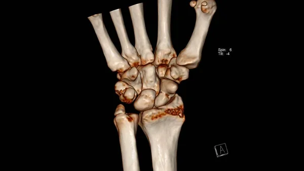 Badanie Radiologiczne Tomografia Komputerowa Objętość Badanie Stawu Nadgarstkowego Nadgarstka Wykazujące — Zdjęcie stockowe