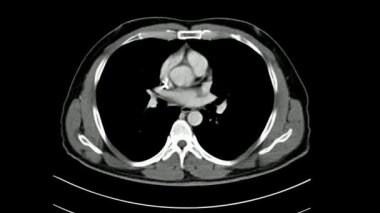 Göğüs, karın ve pelvis röntgenleri, oral ve damar içi kontrast yönetim ekseni düzlemine sahip bir erkek hastaya kötü huyluluk tanısı için bilgisayarlı tomografi (CT) taraması (CT scan)