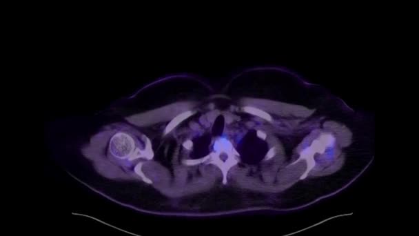 Pet Skanowanie Całego Ciała Głowy Palców Techniką Łączenia Tomografii Komputerowej — Wideo stockowe