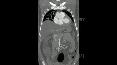 Koronal düzlem sinüs modu (Abdominal Aortogram CT)