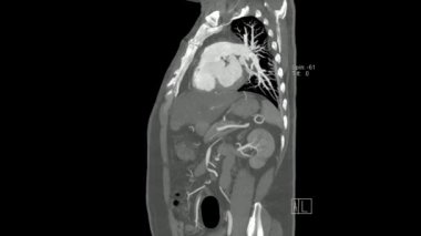 Göğüsten leğene sagital düzlem sinüs modunda Aort 'un hesaplanmış tomografisi (Abdominal Aortogram CT)