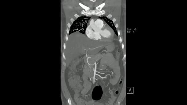 冠状平面正弦模式下主动脉从胸部至骨盆的计算机断层扫描 腹部全息图Ct — 图库视频影像