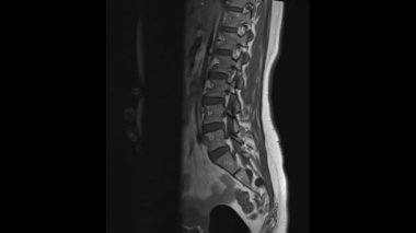Sinir modunda Lumbosacral sagittal T1 ağırlıklı görüntülerin manyetik rezonans görüntüleri (MRI Lumbosacral omurga).
