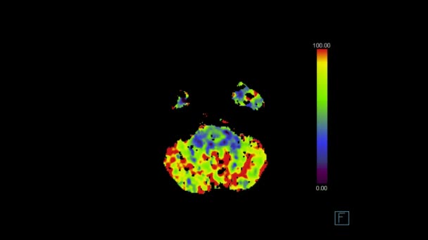 Tomografia Computadorizada Estudo Perfusão Cérebro Humano Rgb Para Detectar Infarto — Vídeo de Stock