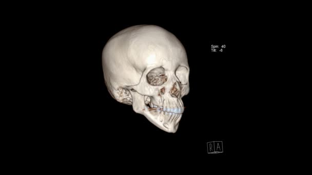 Yüz Kemiklerinin Boyutlu Olarak Hesaplanmış Tomografisi Yüz Kemikleri — Stok video
