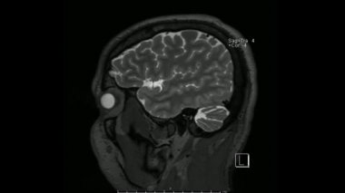 Beynin manyetik rezonans görüntüleri (MRI beyin) sagittal T2 normal anatomiyi gösteren sinüs modunda ağırlık sıralaması