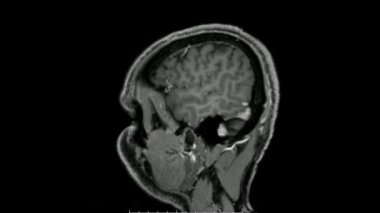 Beynin manyetik rezonans görüntüleri (MRI) sagittal post kontrast dizisi normal anatomiyi gösteriyor