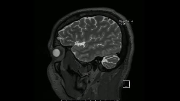 Магнитно Резонансные Изображения Мозга Мрт Мозга Сагиттальной Взвешенной Последовательности Синусовом — стоковое видео