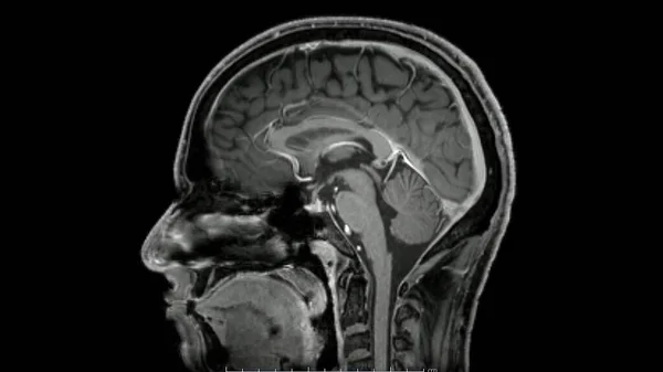 Cine模式下脑矢状矢状对比后序列磁共振图像显示正常解剖 — 图库照片