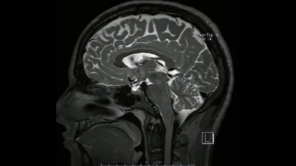 Cine模式下脑 Mri脑 矢状T2加权序列磁共振图像显示正常解剖 — 图库照片