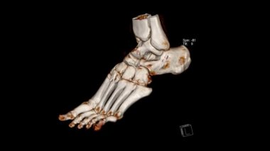 Radyoloji İncelemesi, Bilgisayarlı Tomografi Ses İnceleme Ayağın İncelemesi (CT VR Foot)