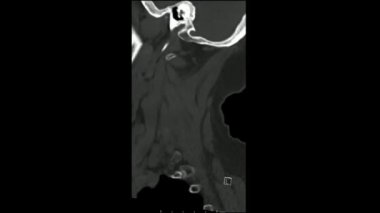 Radyoloji incelemesi, servikal omurga (CT CS) sagittal taraması sinüs modunda