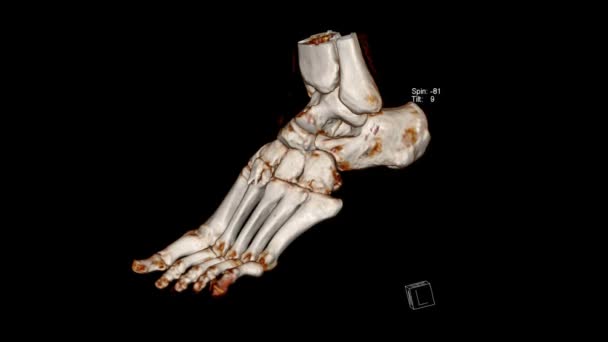 Exame Radiológico Tomografia Computadorizada Volume Renderização Exame Foot — Vídeo de Stock