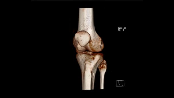 Examinarea Radiologiei Tomografia Computerizată Examinarea Volumului Articulației Genunchiului Knee — Videoclip de stoc