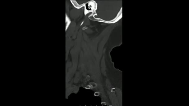 Radiologische Untersuchung Computertomographische Untersuchung Der Halswirbelsäule Sagittal Kinemodus — Stockvideo