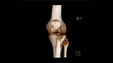 Radyoloji incelemesi, Bilgisayarlı Tomografi Bölümü Dizeklem İnceleme İncelemesi (CT VR Knee). 3B görüntüleme