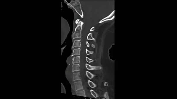 Radiology examination, Computed Tomography examination of the  Cervical spine ( CT CS) sagittal in cine mode