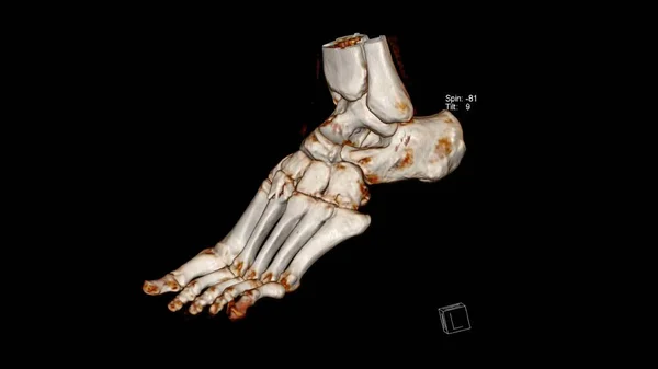 放射科检查 电脑断层扫描 足部体积显示检查 Vr足部 3D渲染 — 图库照片