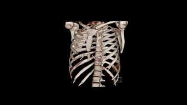 Torasik kafesin (CT VR torasik kafes) hesaplanmış Tomografi Ses İncelemesi. Radyoloji İncelemesi.