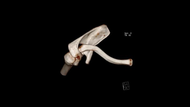 Tomografia Computadorizada Volume Renderização Exame Ombro Ombro Radiologia Exame — Vídeo de Stock