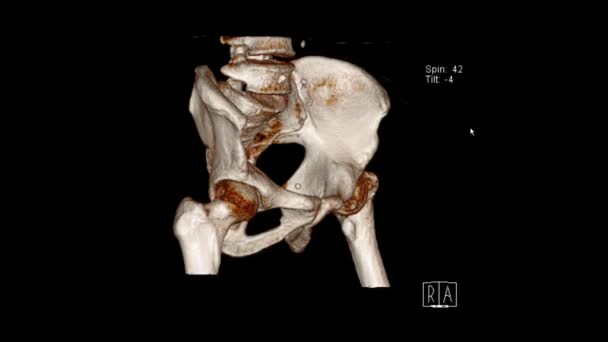 Datortomografi Volym Utförande Undersökning Bäckenet Visar Vänster Lårbenshalsfraktur Bäckenet Radiologisk — Stockvideo