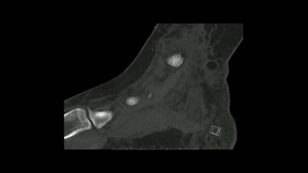 Tomografia Komputerowa Stopy Płaszczyźnie Strzałkowej Wskazująca Złamanie Kości Piętowej Kości — Wideo stockowe