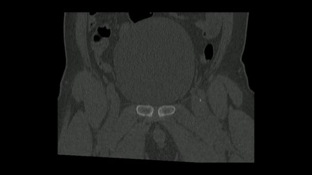Tomodensitométrie du bassin dans le plan coronal montrant une fracture du col du fémur gauche (CT Pelvis) Examen radiologique