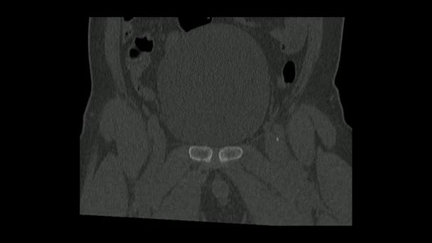 Computertomographie Des Beckens Koronaler Ebene Mit Linker Oberschenkelhalsfraktur Becken Radiologische — Stockvideo