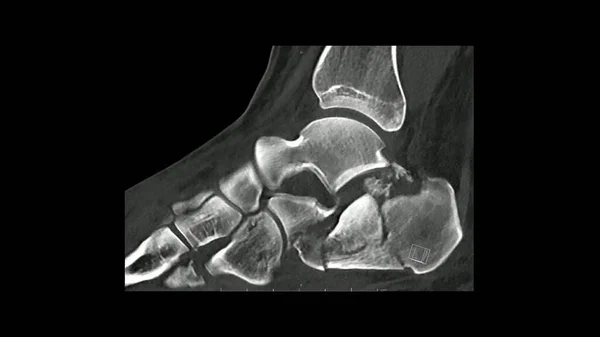 矢状面足部计算机断层扫描显示跟骨骨折 Ct足部 — 图库照片
