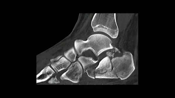 Комп Ютерна Томографія Стопи Сагітальній Площині Показує Перелом Яткової Яткової — стокове фото