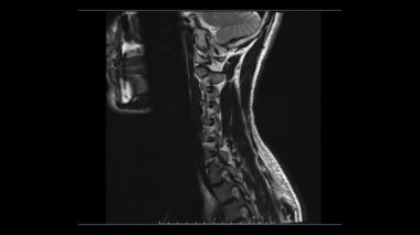 Servikal sagittal T2 ağırlıklı görüntülerin Cine modunda (MRI Servikal Omurga) hafif disk hastalığını gösteren manyetik rezonans görüntüleri.