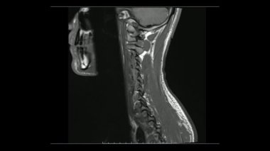 Servikal sagittal T1 ağırlıklı görüntülerin Cine modunda (MRI Servikal Omurga) hafif disk hastalığını gösteren manyetik rezonans görüntüleri.
