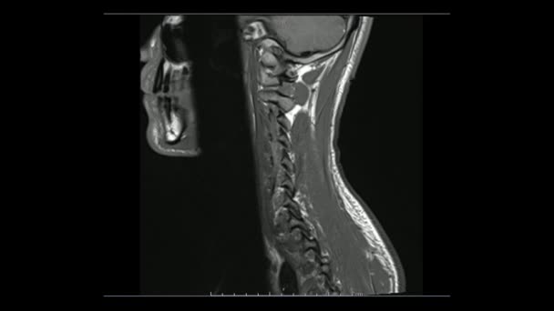 ภาพสะท อนแม เหล กของกระด นหล อนคล าหน กภาพในโหมดภาพยนตร Mri Cervical — วีดีโอสต็อก