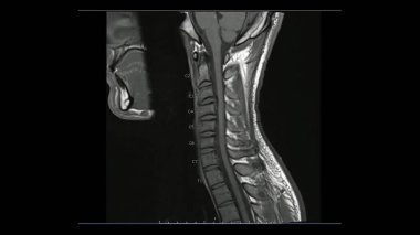 Servikal sagittal T1 ağırlıklı görüntülerin (MRI Servikal Omurga) hafif disk hastalığını gösteren manyetik rezonans görüntüleri.