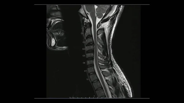 颈椎矢状T2加权图像 Mri颈椎 显示轻度椎间盘病变的磁共振图像 — 图库照片