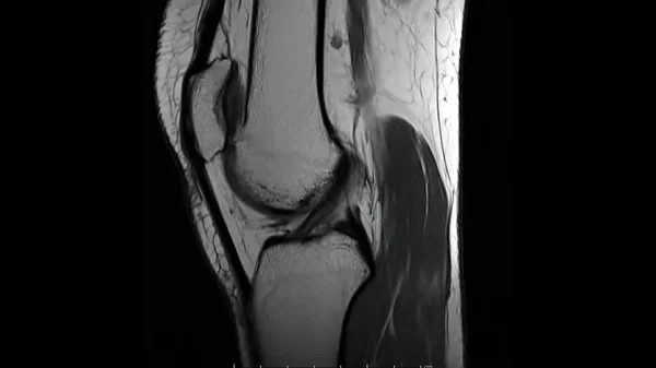 Imágenes Resonancia Magnética Articulación Rodilla Imágenes Ponderadas Por Sagittal Articulación —  Fotos de Stock