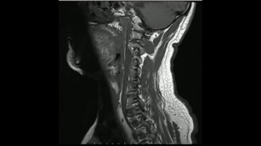 Cine modunda servikal sagittal T1 ağırlıklı görüntülerin (MRI Servikal Omurga) manyetik rezonans görüntüleri, C5-6 diskinde daha belirgin olan çoklu disk hastalığını göstermektedir.