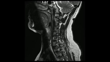 Cine modunda servikal sagittal T2 ağırlıklı görüntülerin (MRI Servikal Omurga) manyetik rezonans görüntüleri, C5-6 diskinde daha belirgin olan çoklu disk hastalığını göstermektedir.