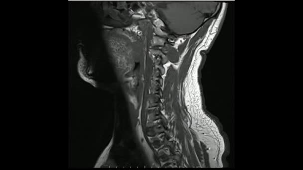 Magnetische Resonantie Beelden Van Cervicale Wervelkolom Sagittal Gewogen Beelden Cine — Stockvideo