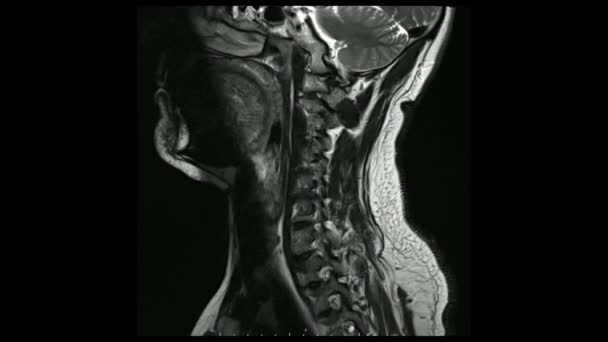 Imágenes Por Resonancia Magnética Columna Cervical Sagital Imágenes Ponderadas Por — Vídeos de Stock